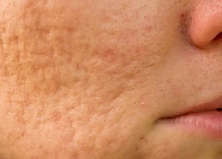 Subcision for Acne Scars